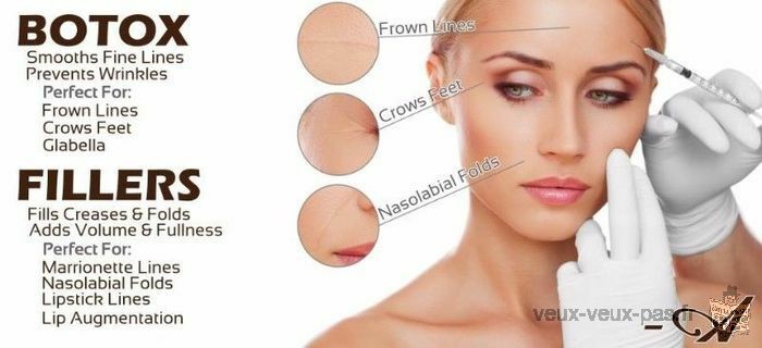 Botox,Juvederm / lèvres Restylane